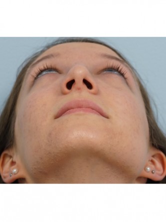 Prominent Nose Closed Rhinoplasty* — After