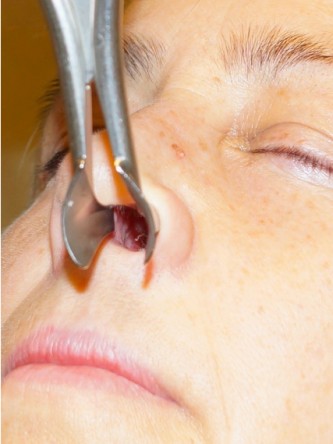 Nasal Septal Perforation2* — After