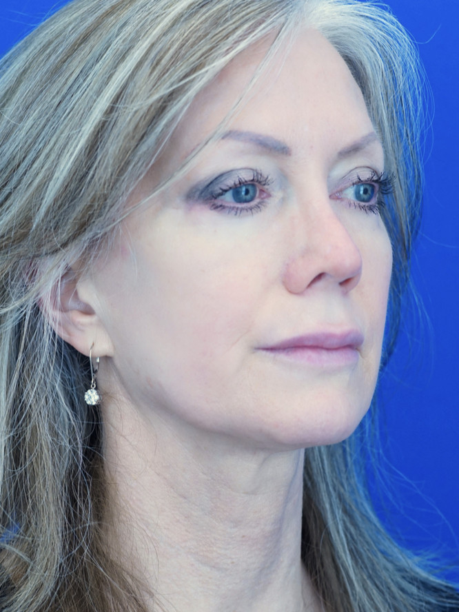 Upper Lip Fullness — Before