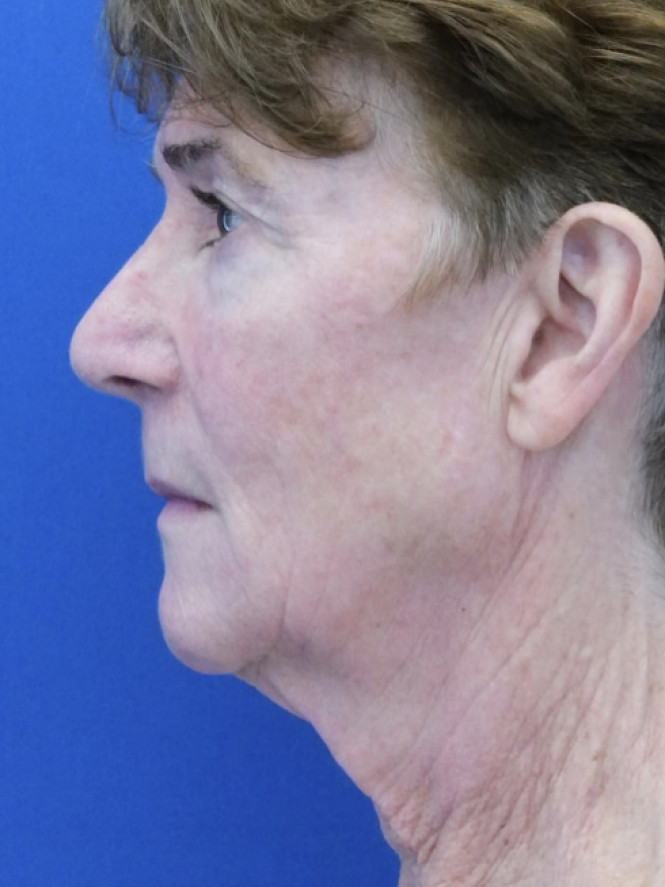 Deep Plane Facelift and Eyelid Lift — Before