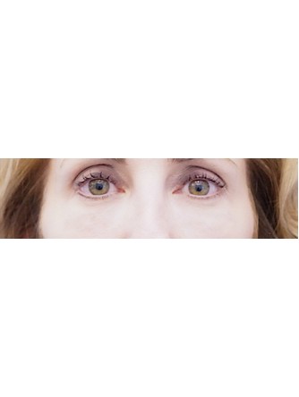 Filler for Under Eye* — After