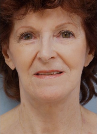 Facelift, Necklift, Platysmaplasty, ERB:YAG Laser Resurfacing* — After