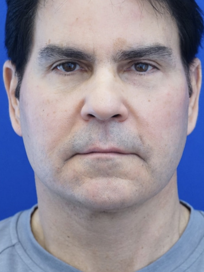 Male Facelift — After