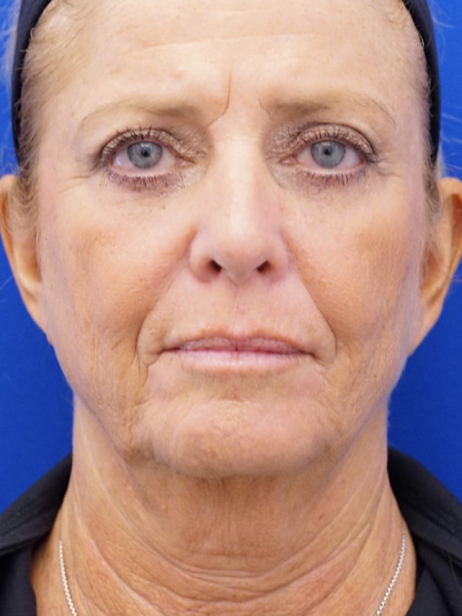 Deep Plane Lower Facelift — Before