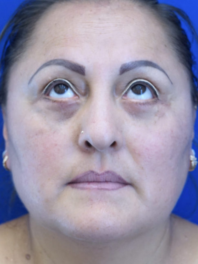 Lower Blepharoplasty Fat Reposition — After