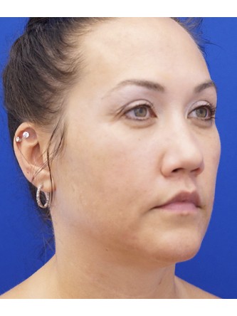 Bull Horn Lip Lift — After