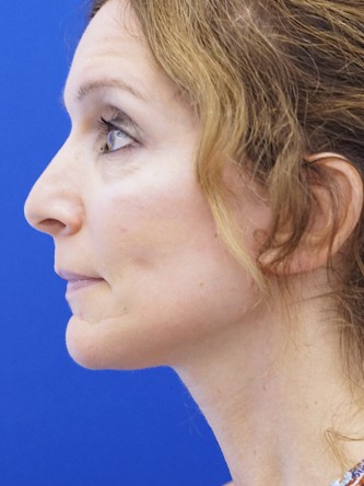 Mild Neck Skin Laxity — After