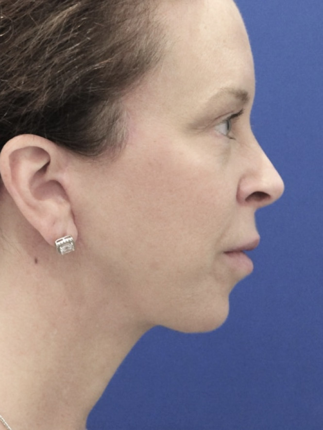 Jowling and Skin Laxity — After