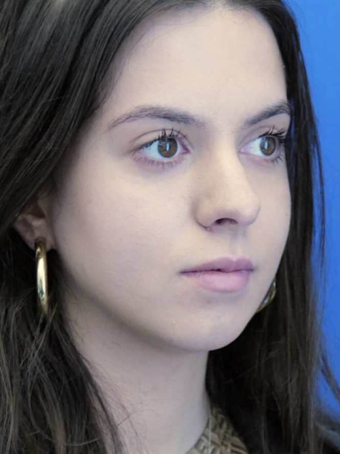 Preservation Rhinoplasty2 — Before