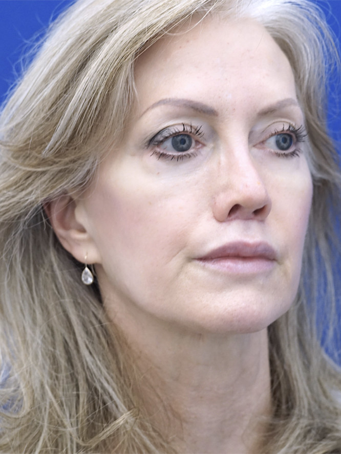 Upper Lip Fullness — After