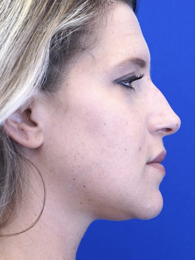 Aesthetic Nasal Profile — Before