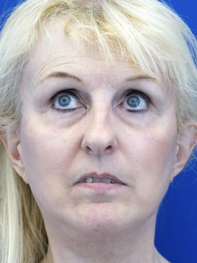 Subciliary Blepharoplasty Fat Reposition — Before