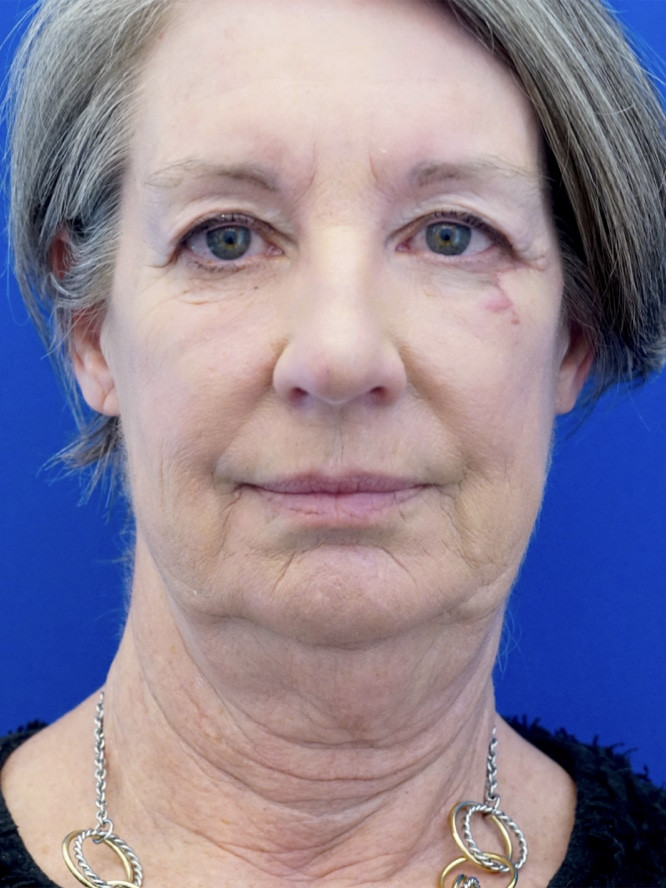 Deep Plane Face and Neck Lift — Before