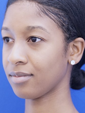 Ethnic Rhinoplasty* — Before