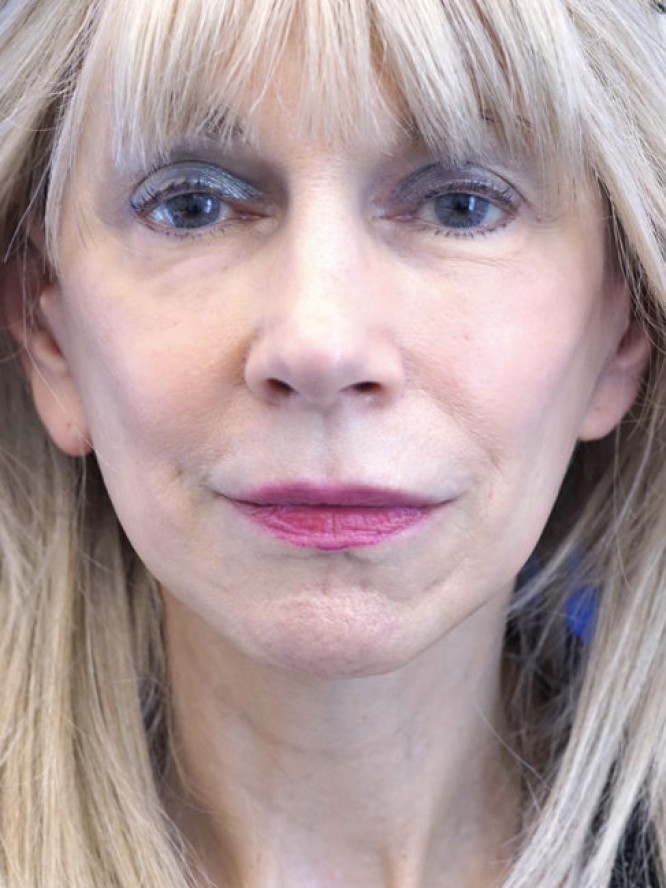 Crisp Jaw and Neck Lines — After
