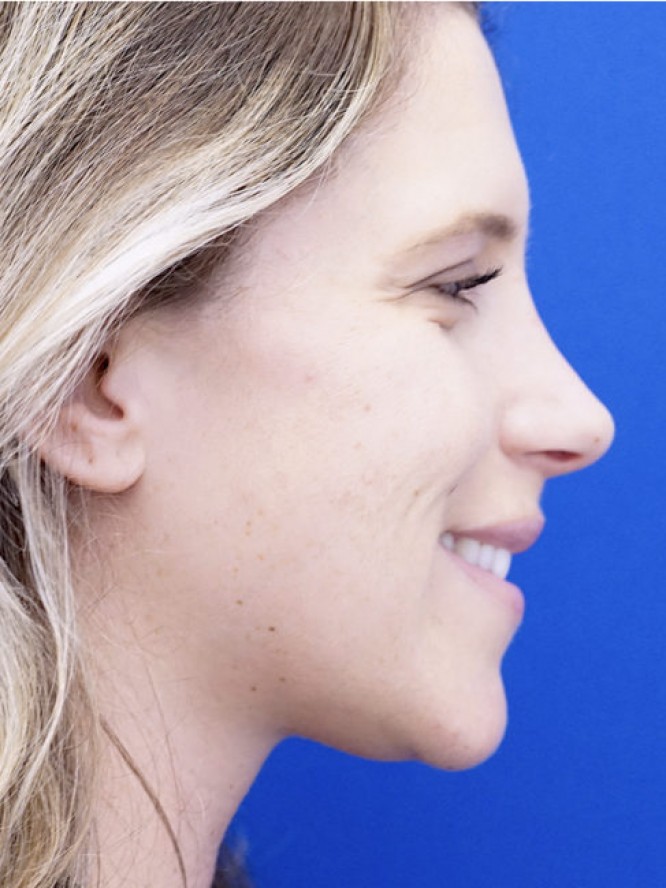 Aesthetic Nasal Profile — After