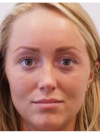 Restylane Silk to Upper & Lower Lips* — Before