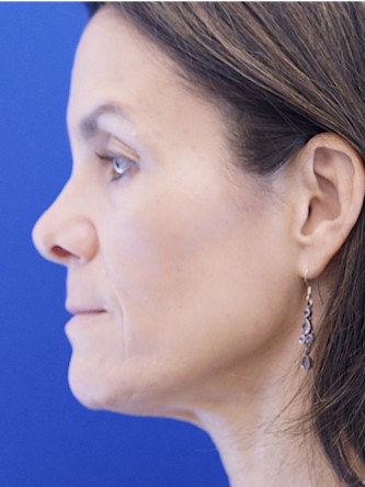Nasal Tip Deformity — Before