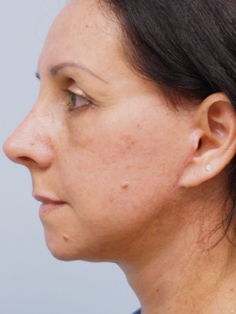 Aging Eyelid Rejuvenation, Facelift, Necklift 2* — After