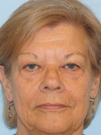Upper Eyelid Droop and Skin Excess* — Before