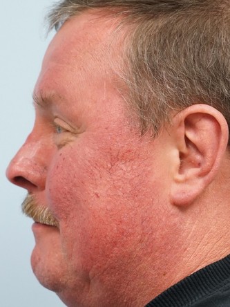 Rhinophyma* — After