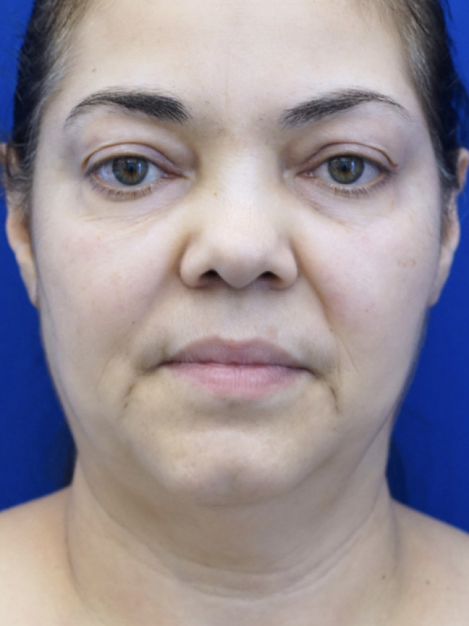 Deep Plane 2 Years Result — Before