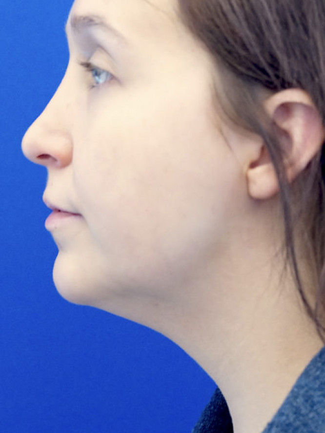 Necklift Subplatysmal Lipectomy — Before
