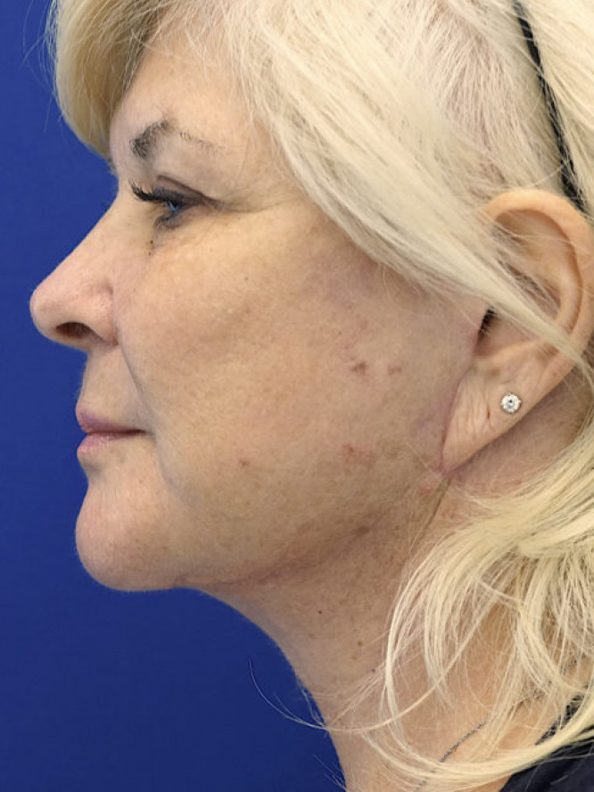 Amazing Transformation — After