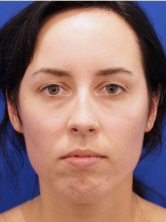 Chin Implant and Upper Lip Filler* — Before
