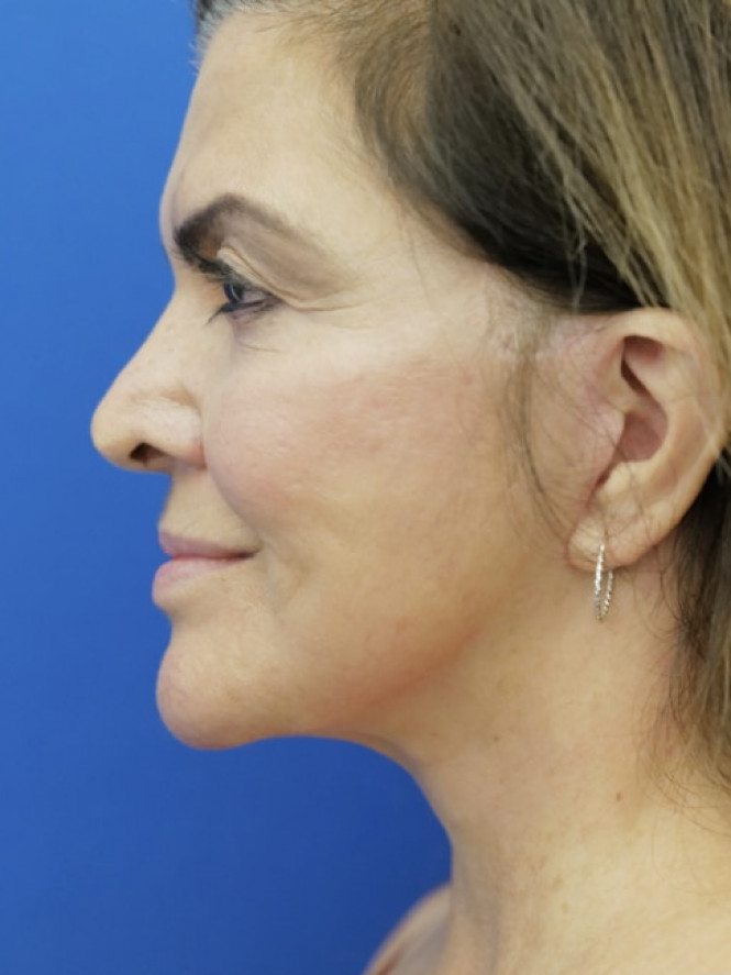 Lower Facelift Chin Reduction — After