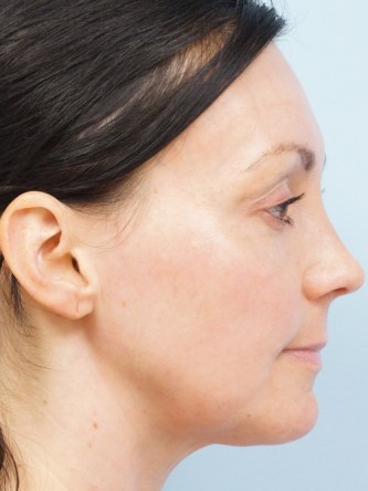 Fractional CO2 Laser Skin Resurfacing2* — After