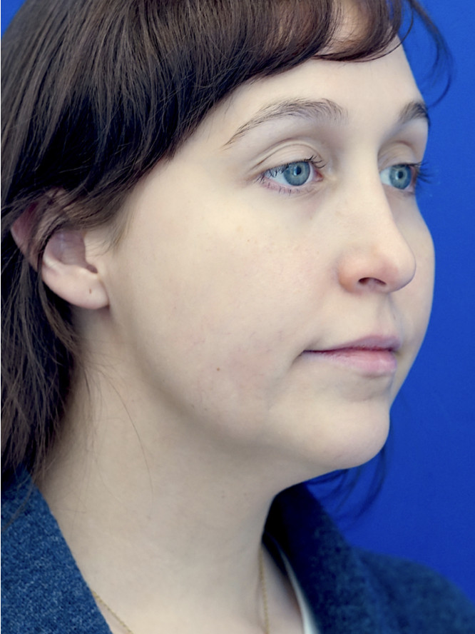 Necklift Subplatysmal Lipectomy — Before