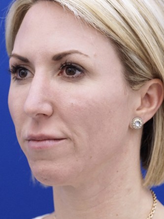 Aesthetic Nasal Contour* — Before