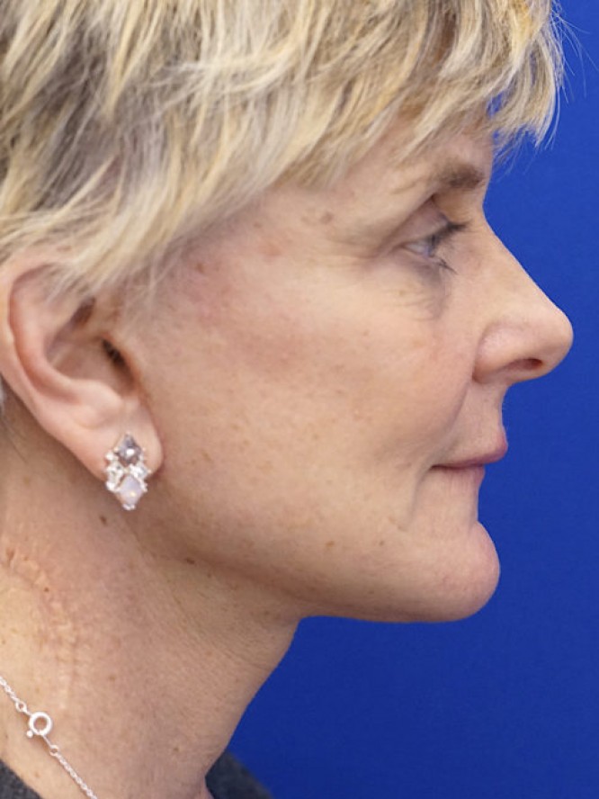 Lower Facelift Deep Plane — After