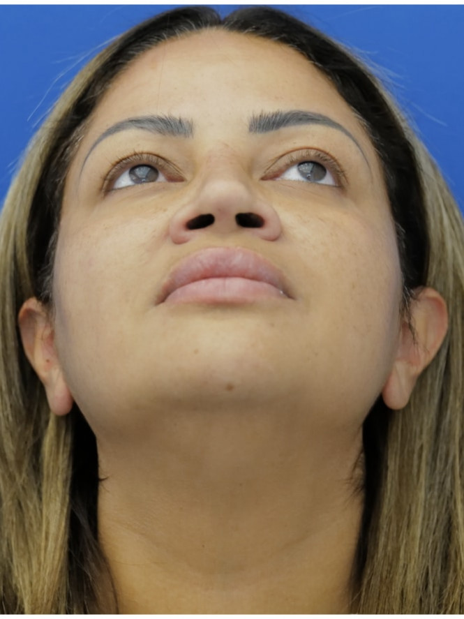 Narrow Nostril Base — Before
