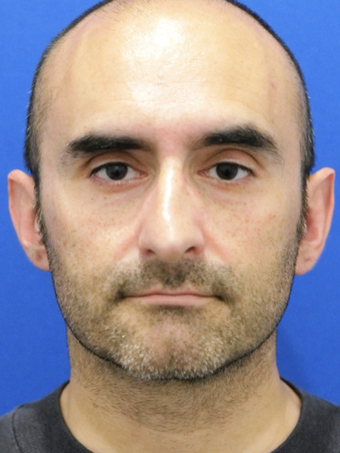 Tension Tip Ptosis — Before
