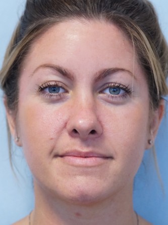 Boxy Tip Endonasal Rhinoplasty* — After