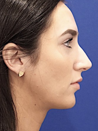 Nasal Hump Closed Rhinoplasty — Before