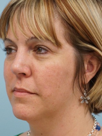 Cheek Augmentation using Voluma* — Before