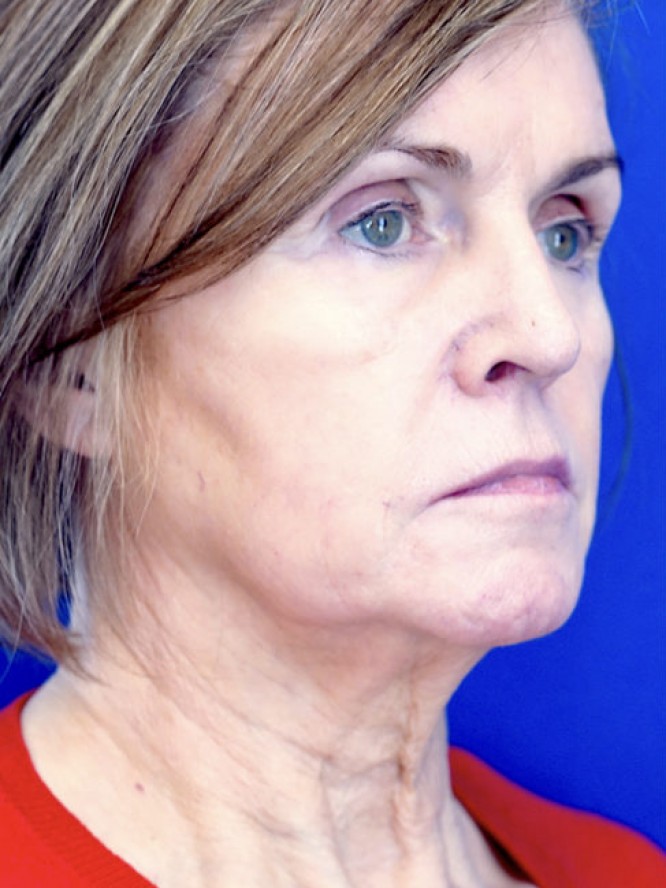 Deep Plane Lift and Fat Grafting — Before