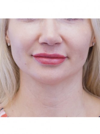 Finesse Tip Rhinoplasty — After