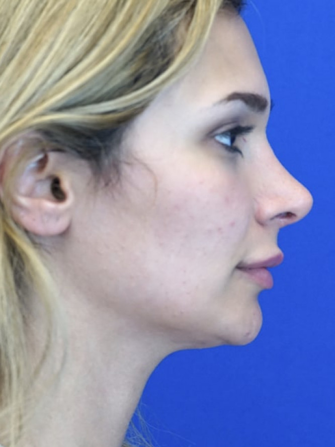 Nasal Deviation and Dainty Tip — After