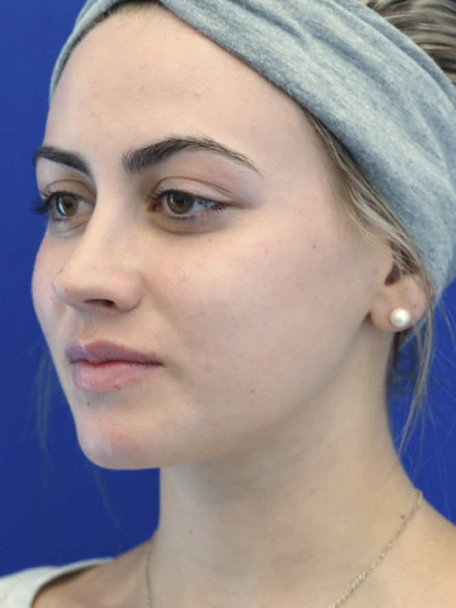 Smooth Dorsal Contour — After