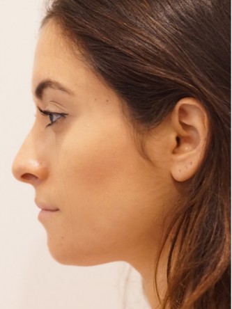 Restylane Silk to Volumize Lower Lip* — Before