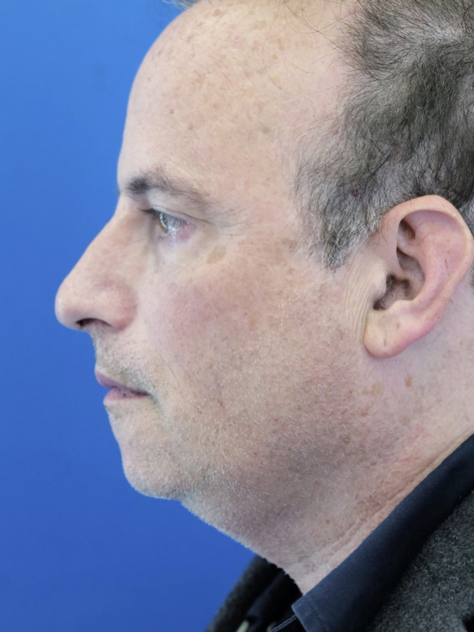 Chin Implant Reposition — Before