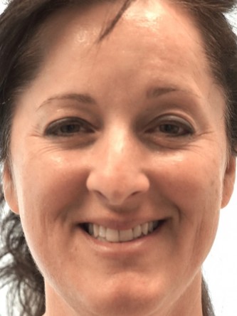 Botox Periorbital – Around the Eyes* — Before