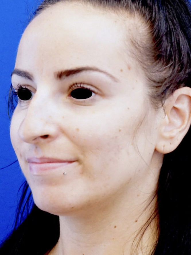 Nasal Tip Refinement — Before