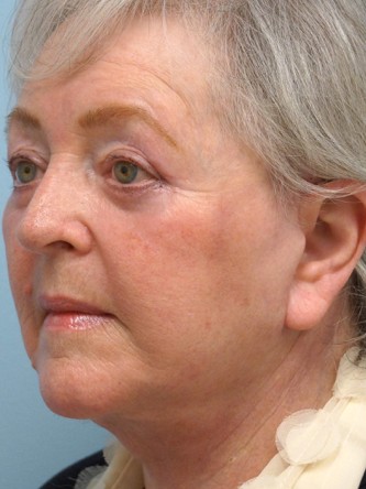 Aging Eyelid, Facelift, Necklift, Fractional CO2 Laser Resurfacing* — After
