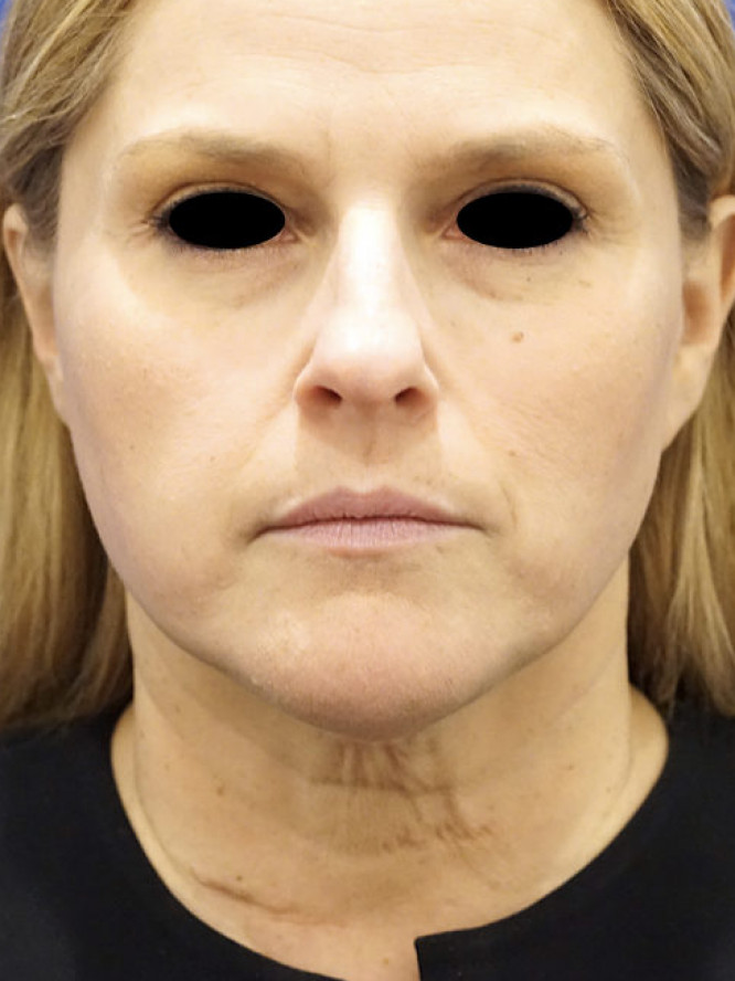 Deep Plane Lower Facelift and Platysmaplasty — Before