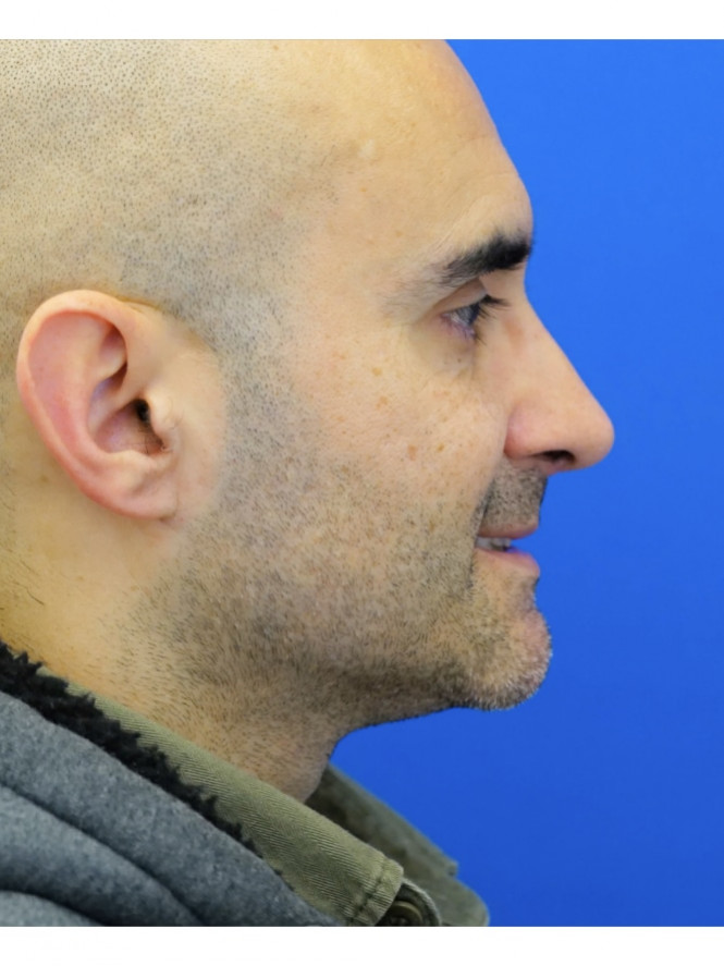Tension Tip Ptosis — After